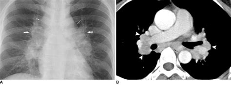 Hilar Lymphadenopathy Ct Scan