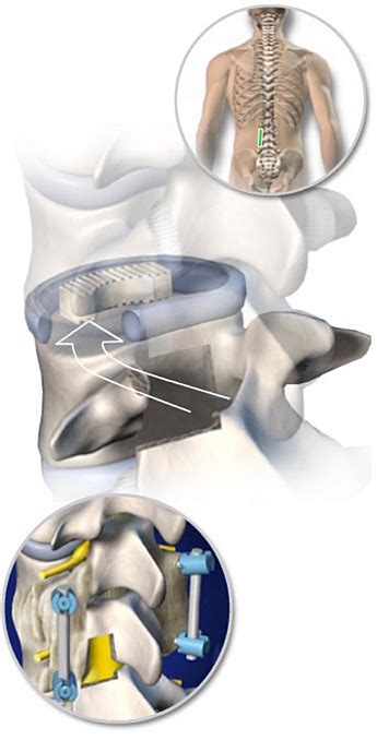 Tlif Transforaminal Lumbar Interbody Fusion Central Coast Orthopedic