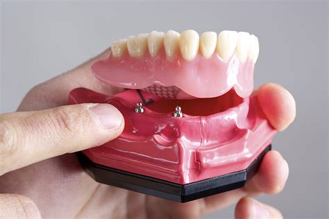 implant supported dentures vernon denture clinic