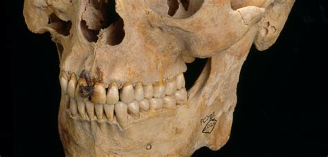 Gum Disease Worse Now Than In Roman Britain Natural History Museum