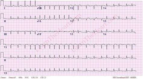 Atrial Fibrillation With Rapid Ventricular Rate Example 3 Learn The