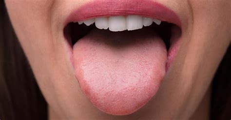 sore tongue 13 possible causes and treatment