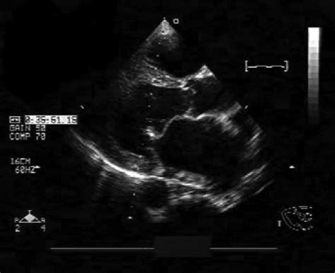 Rheumatic Mitral Valve With Moderate To Severe Stenosis