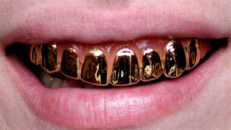 permanent gold teeth procedure gold choices
