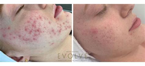 acne treatments clear skin results  evolve evolve private