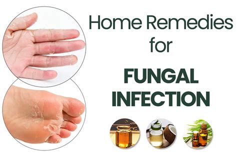 top  home remedies  fungal infection  ayurveda
