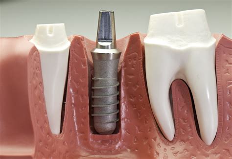 learn    benefits  titanium dental implants