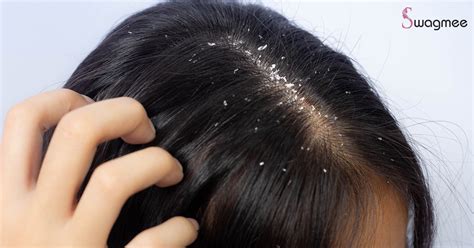 common dandruff myths busted