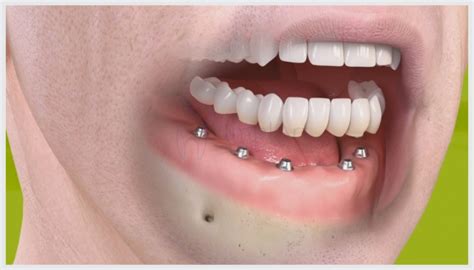 quanto custa implante dentário consulta ideal