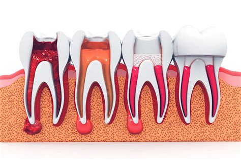 root canal treatment berry lane dental surgery dentists  longridge preston