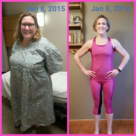 Before And After 1 Year Gastric Sleeve Anniversary