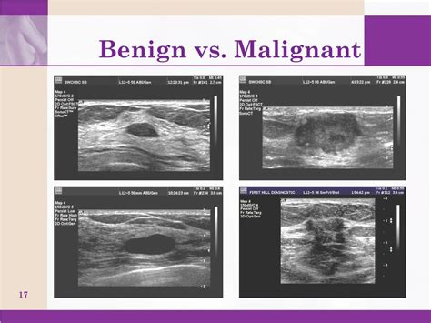 Benigni Difference Between Malignant And Benign Tumor