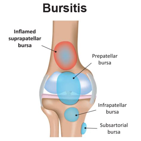 bursitis knee pain carolinas pain center pain relief options