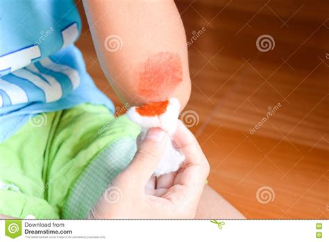 kids clean  wound hand stock image image  accident