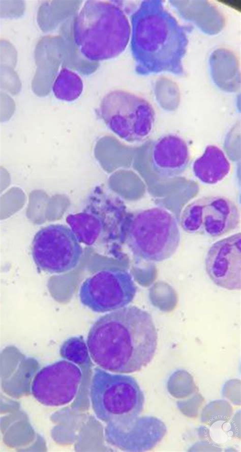 multiple myeloma bone marrow
