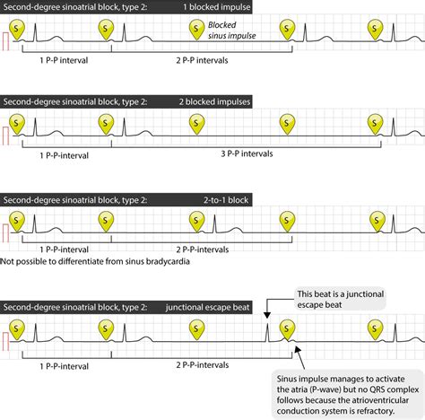 sinoatrial block sa block ecg criteria   clinical features