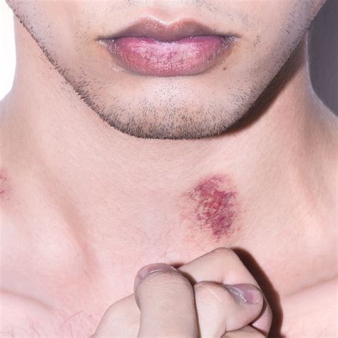 how to get rid of a hickey if you somehow are still