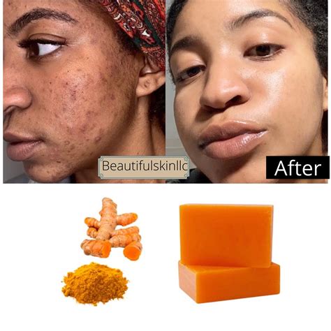 turmeric kojic bar soap dark spots remover acne remover etsy skin soap remove dark spots