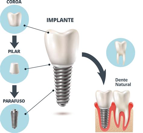 Implante Dentario And Próteses – Enleva Odontologia Integrada