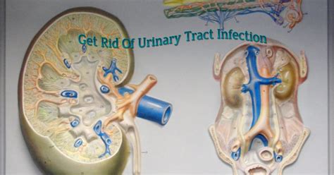 Home Remedies For Urinary Tract Infection Healthy Lifestyle