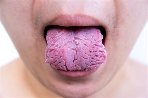 many cracks on tongue fissured tongue health remedies joyful belly