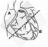 Coronary Artery Occlusion Bypass Treated Grafting Powerpoint Distal Mid sketch template