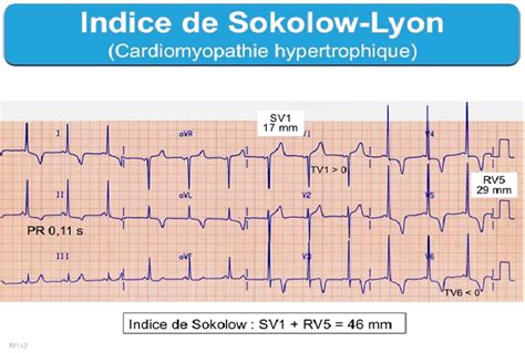 indice de sokolow lyon pdf