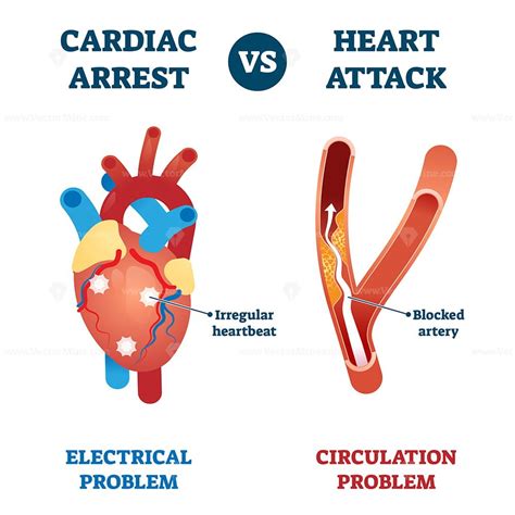 cardiac arrest  heart attack vector illustration vectormine