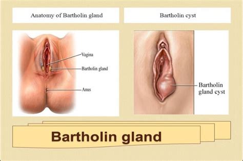 bartholin s cyst health navigator nz
