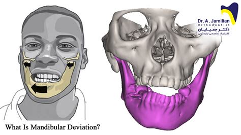 mandibular deviation dr jamilian
