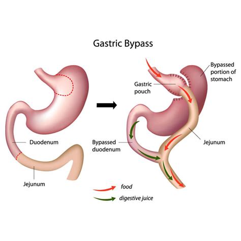 Gastric Mini Bypass Surgery دکتر سجاد نورشفیعی جراحی اسلیو معده