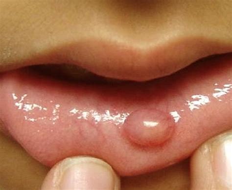 healthool bumps on lips causes treatment pictures 2021 updated