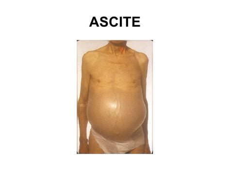 Ascite