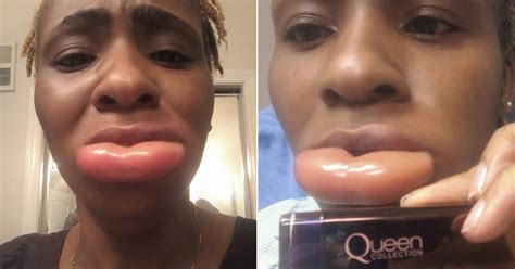 Girl Ends Up With Gigantic Lip After Having Severe Reaction To Lipstick