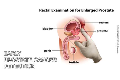 Early Prostate Cancer Detectionmec Best Penile