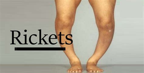 Rickets Causes Symptoms Diagnosis Prevention Treatment