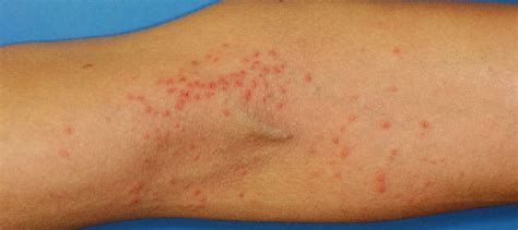 rashes treatment medication philadelphia eczema psoriasis vitiligo pa