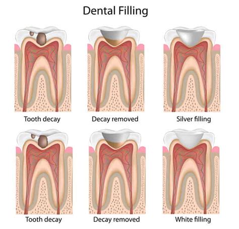 tooth colored filling mcdonough ga family dentistry