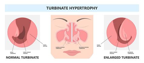 large inferior turbinate symptoms  diagnosis  treatment
