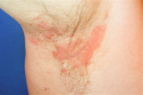 seborrheic dermatitis symptoms treatment  locations