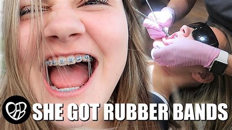 rubber bands  rubber bands   braces braces vlog