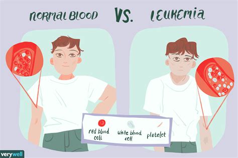 leukemia overview