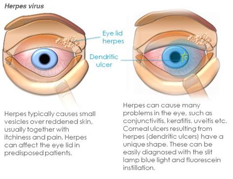 Corneal Abrasion And Ulcer Clinica London Harley Street