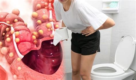 bowel cancer symptoms rectal bleeding is a sign of the disease and