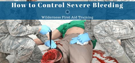 aid  severe bleeding