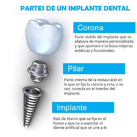 ¿te Pondrán Un Implante Dental【conoce Todo Lo Que Debes Saber】