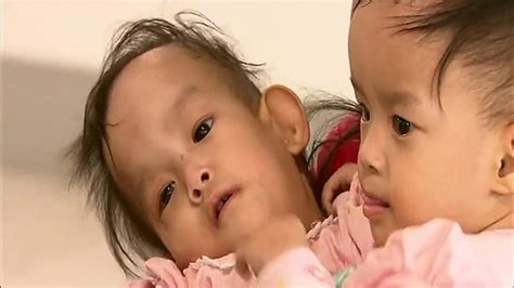conjoined bhutanese twins have been successfully separated following a
