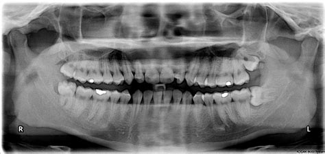 dental extractions  wisdom teeth  hills dentist capstone dental