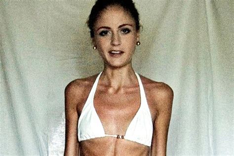 anorexic woman at risk of dying after dropping to 5st looks incredible