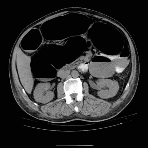ogilvie syndrome ct wikidoc